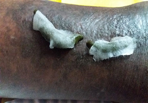 leech therapy in Coimbatore